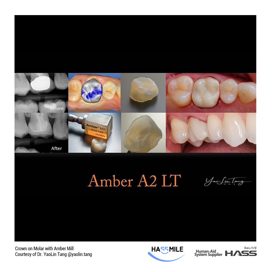Crown on Molar with Amber Mill (MT)