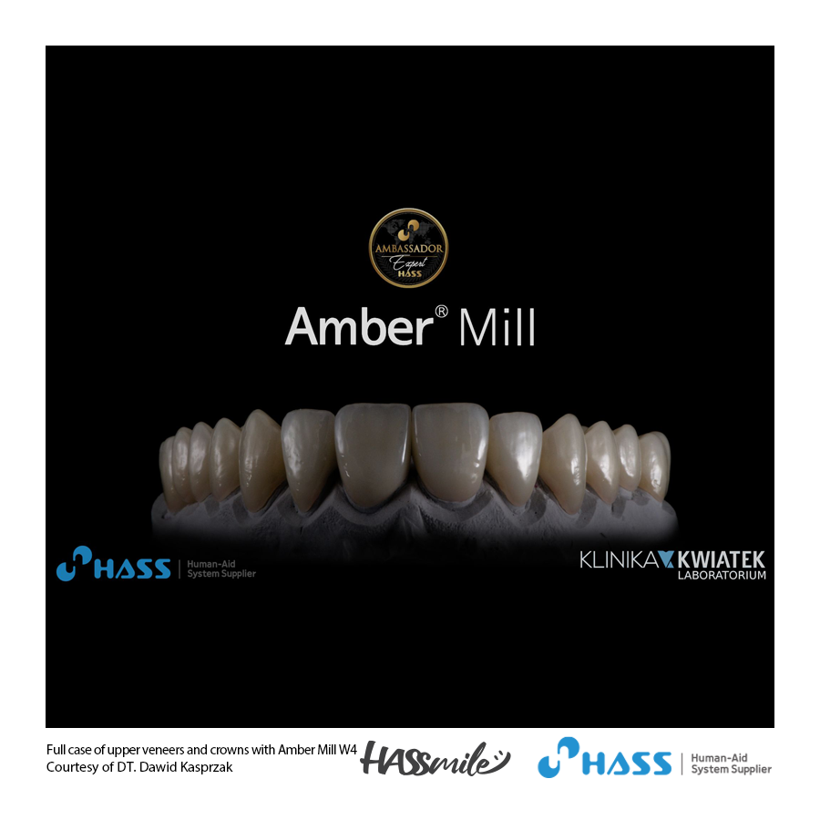 Full case of upper veneers and crowns with Amber Mill W4
