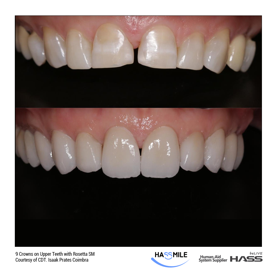 9 Crowns on Upper Teeth with Rosetta SM (HT)