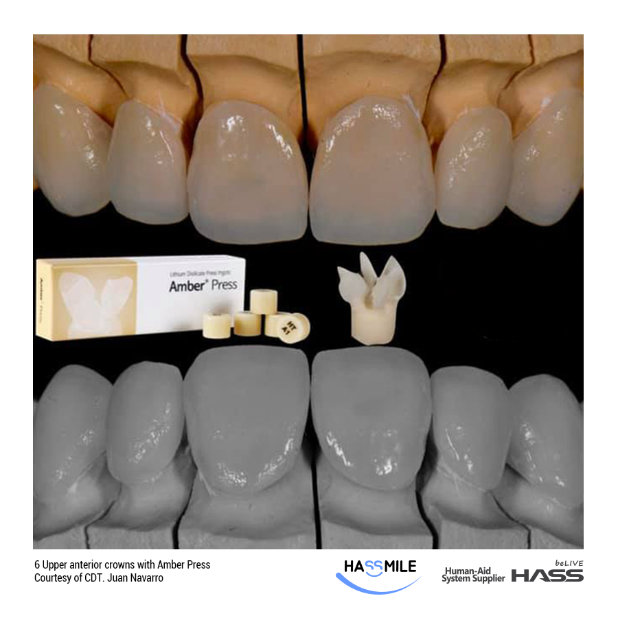 6 Upper anterior crowns with Amber Press