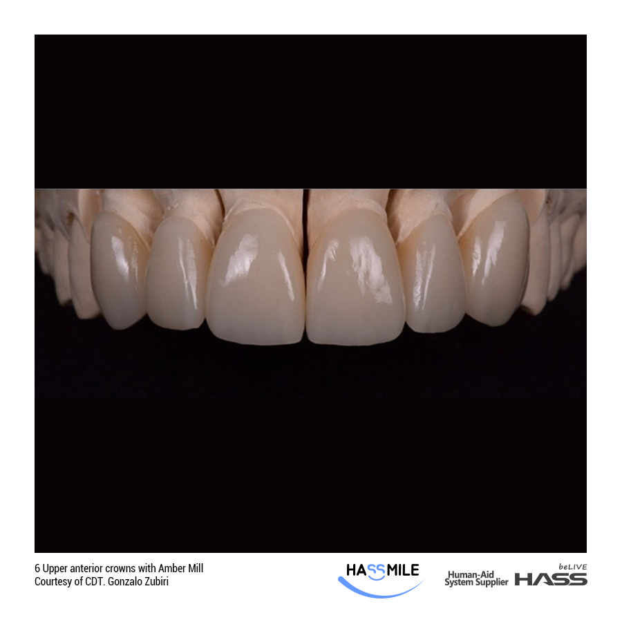 6 Upper anterior crowns with Amber Mill