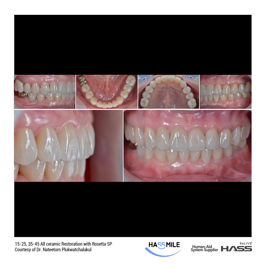 Full Mouth Reconstruction  15-25, 35-45 All ceramic Restoration with Rosetta SP (HT)