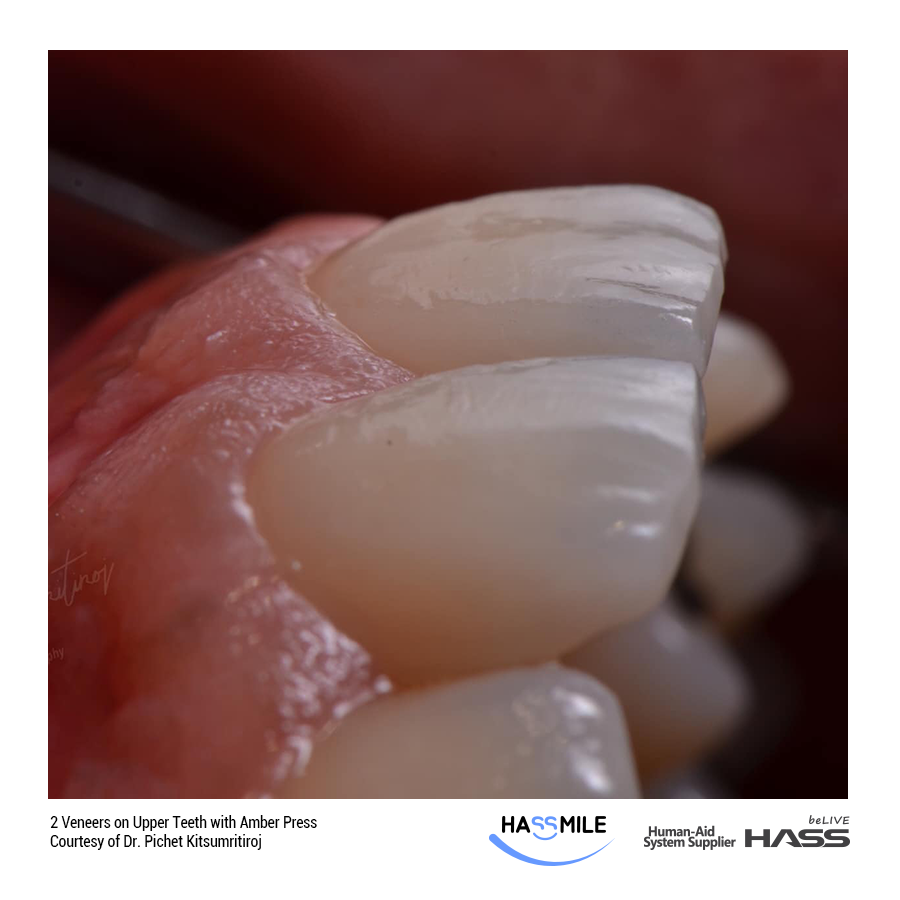 2 Veneers on Upper Teeth with Amber Press(HT)