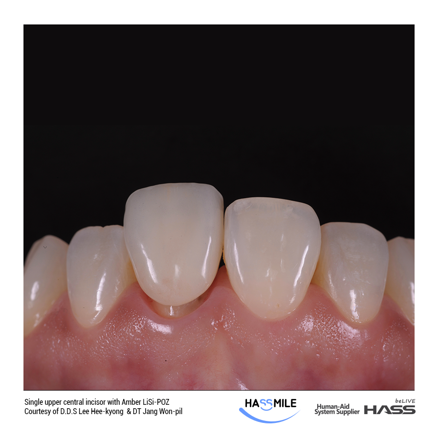 Single upper central incisor with Amber LiSi-POZ