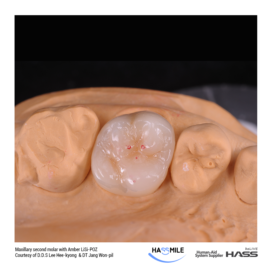 Maxillary second molar with Amber LiSi-POZ
