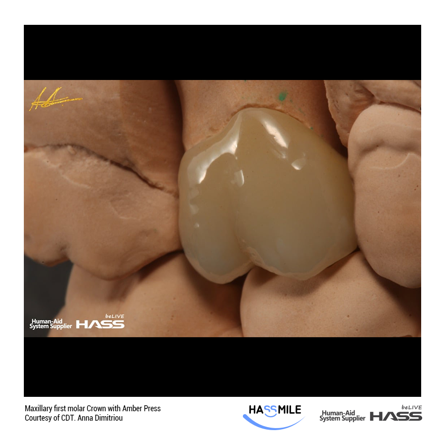 Maxillary first molar Crown with Amber Press