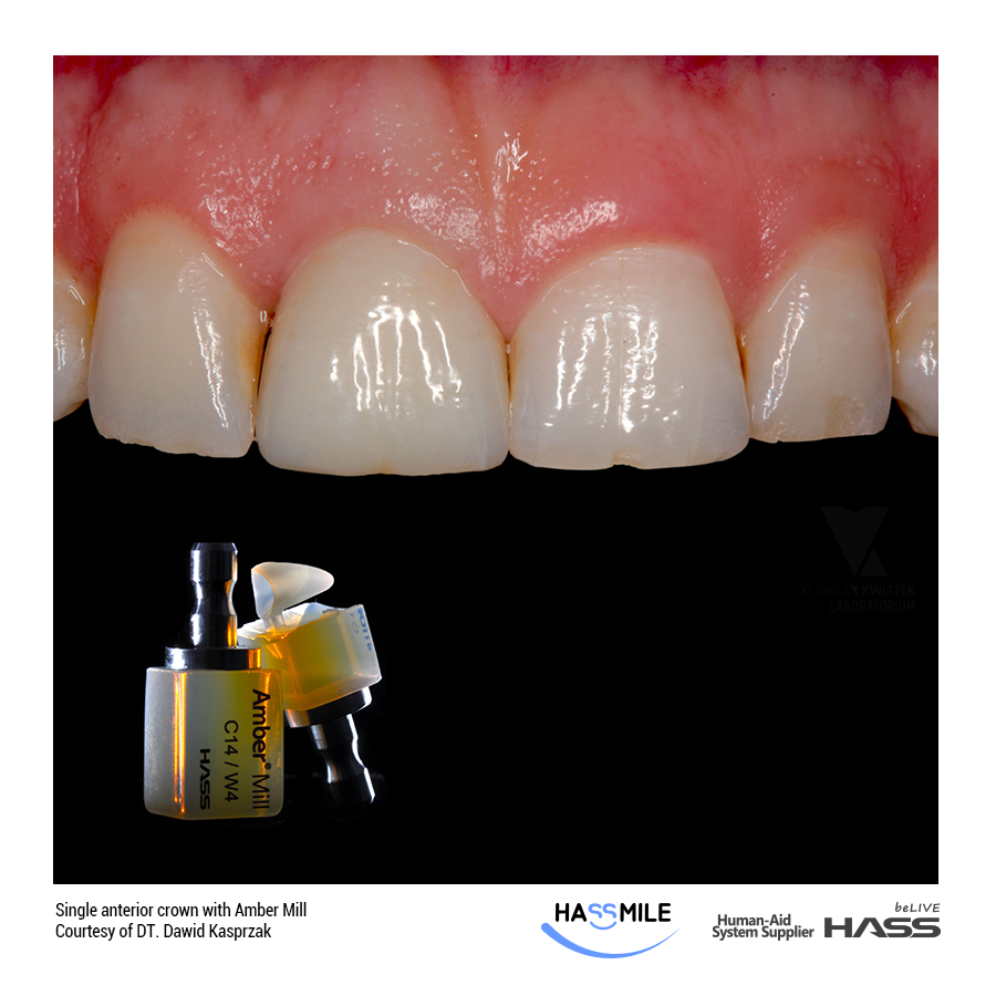 Single anterior crown with Amber Mill (LT)