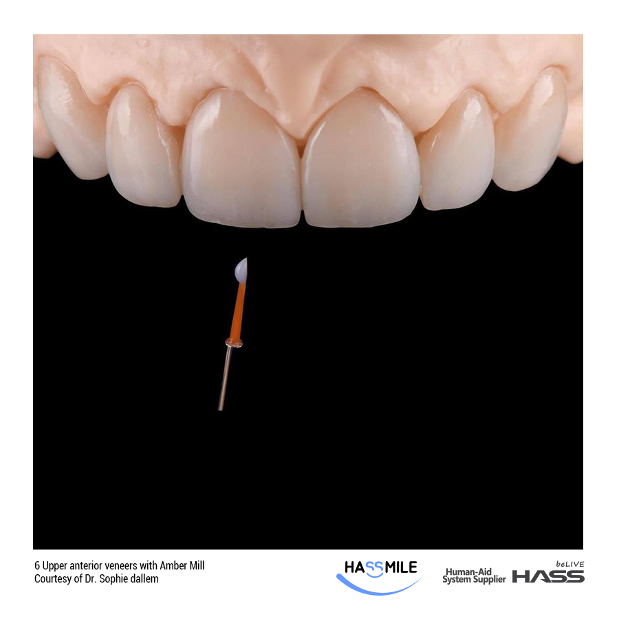 6 Upper anterior veneers with Amber Mill