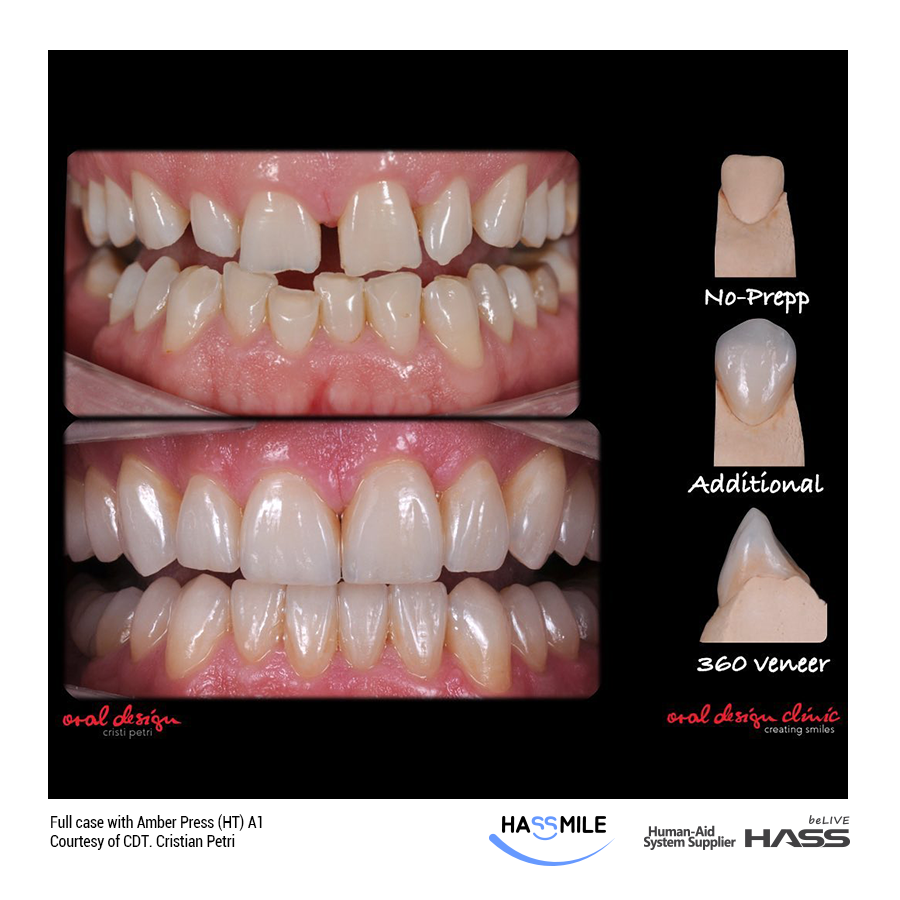 Full case with Amber Press (HT) A1. Minimum prep Veneers for Upper Central Incisals and Lower Incisals. And No prepp for the rest.