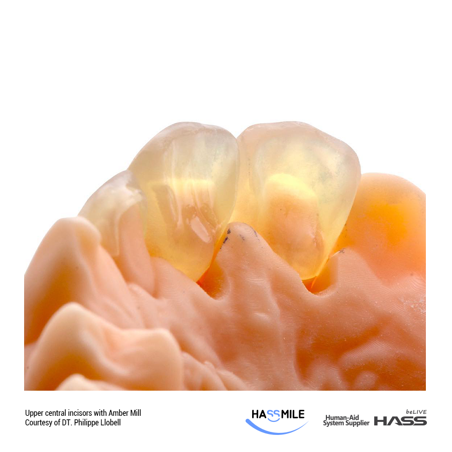 Upper central incisors with Amber Mill