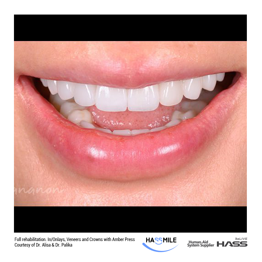 One single crown of central incisor and 7 anteriors veneers with Amber Press (HT) W4