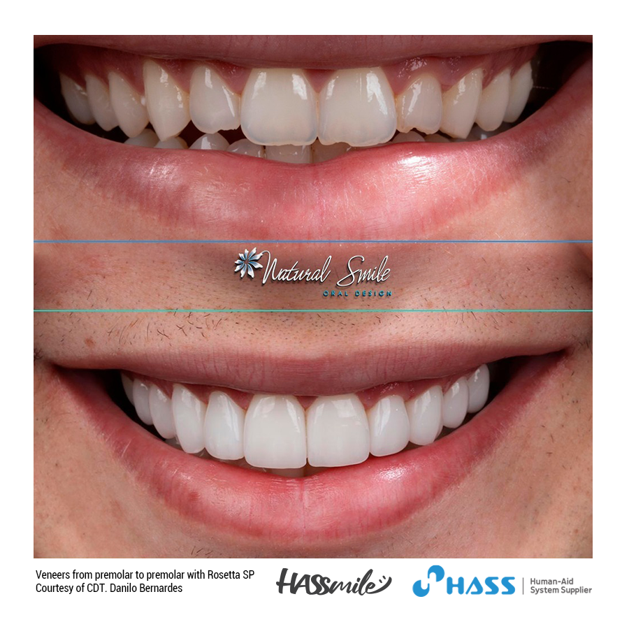 Veneers from premolar to premolar with Rosetta SP (HT) W4