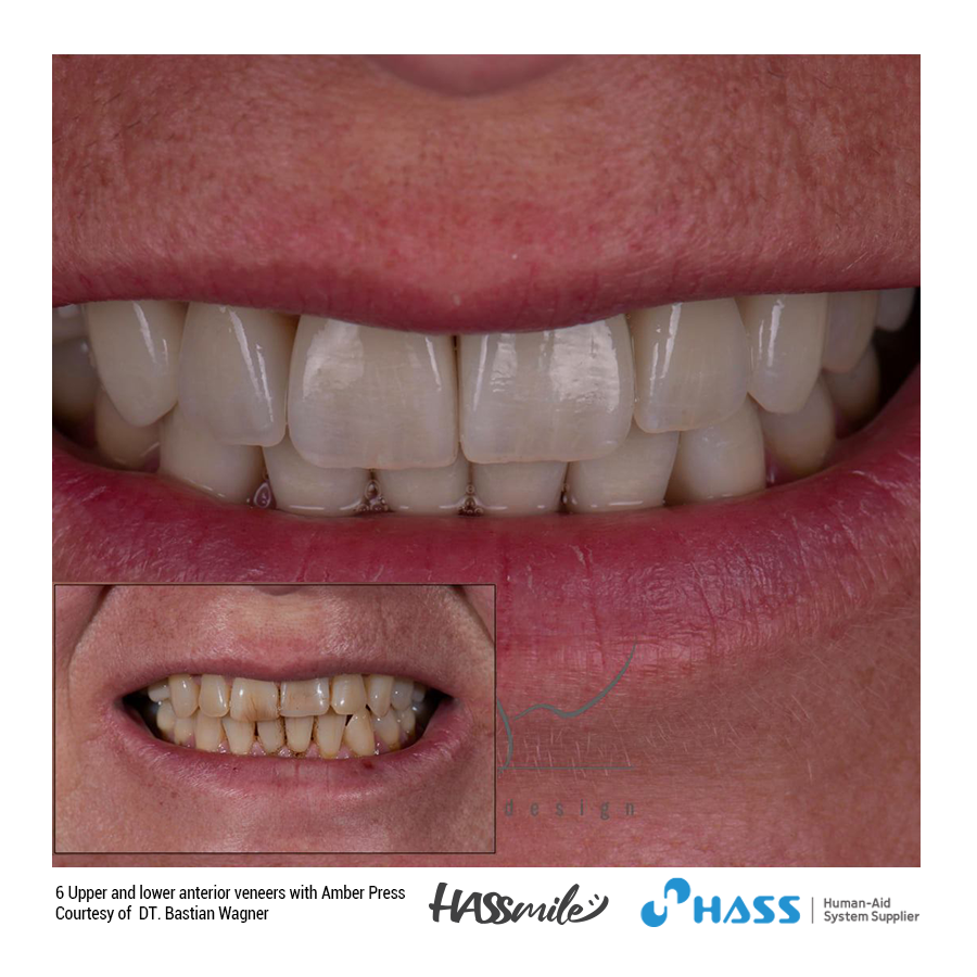 6 Upper and lower anterior veneers with Amber Press