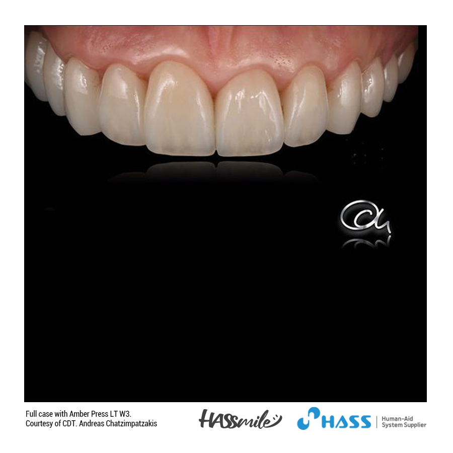 Full case with Amber Press (LT) W3 / Veneers for upper and lower anterior and  table tops for posteriors.