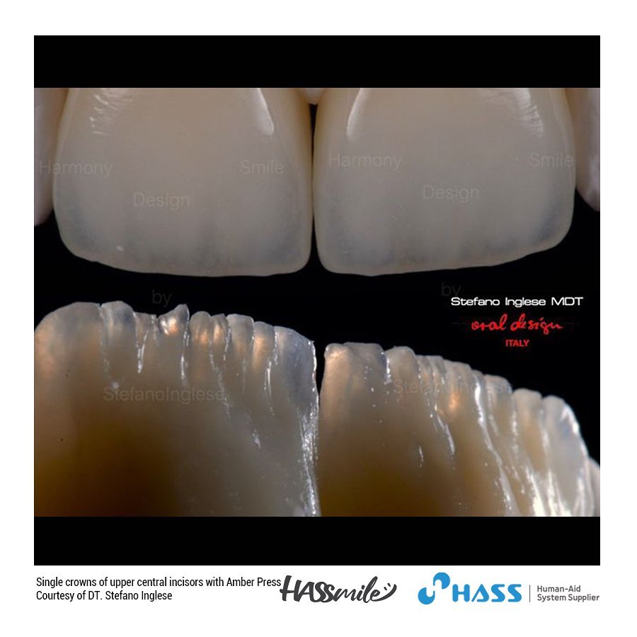 Single crowns of upper central incisors with Amber Press (MO)