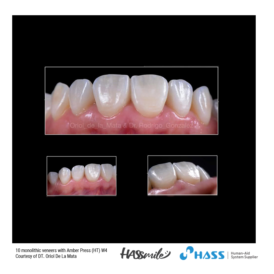 10 monolithic veneers with Amber Press (HT) W4