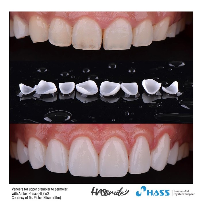 Veneers for upper premolar to permolar with Amber Press (HT) W2