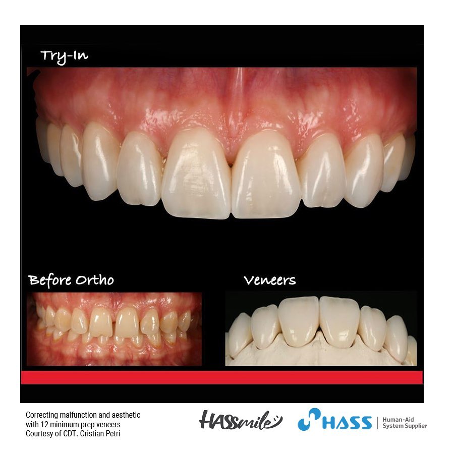Veneers for every premolars and first molars with Amber Mill W3
