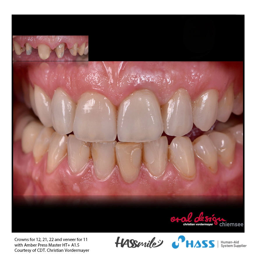 Crowns for 12, 21, 22 and veneer for 11 with Amber Press Master HT+ A1.5
