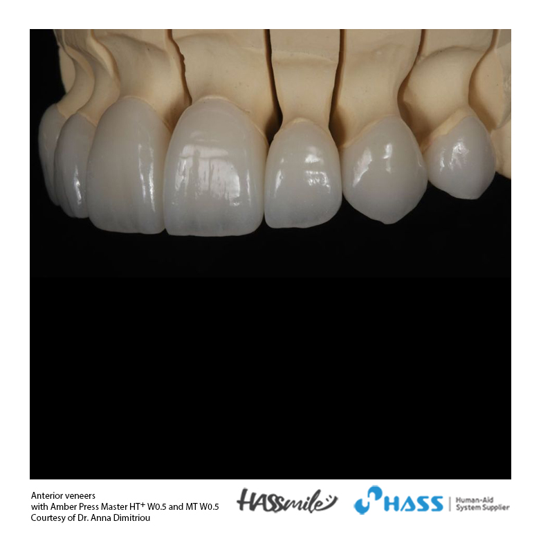 Anterior veneers with Amber Press Master HT+ W0.5 and MT W0.5