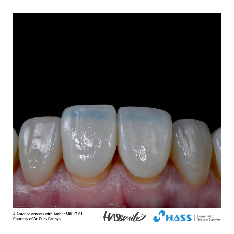4 Anterior veneers with Amber Mill HT B1