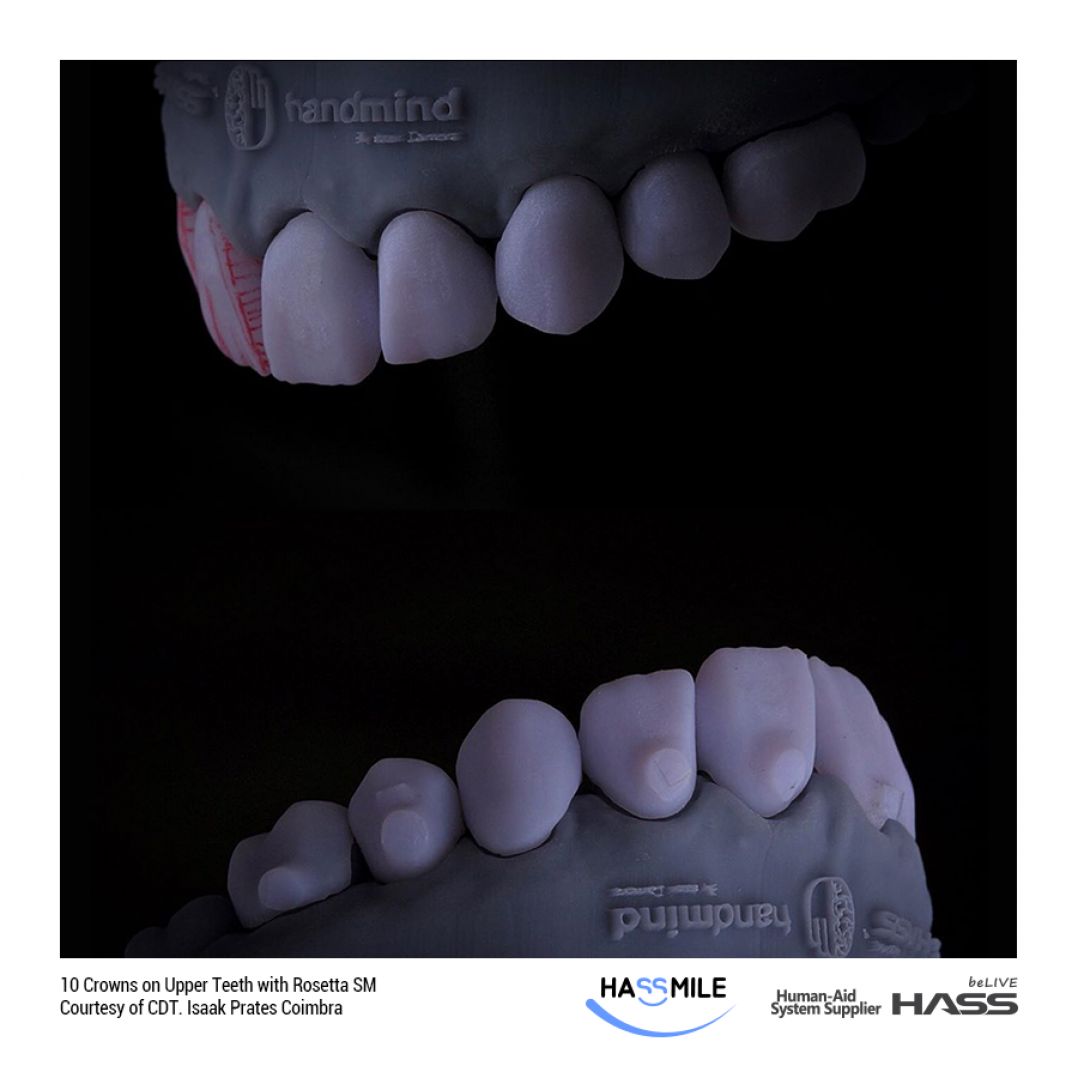 10 Crowns on Upper Teeth with Rosetta SM 