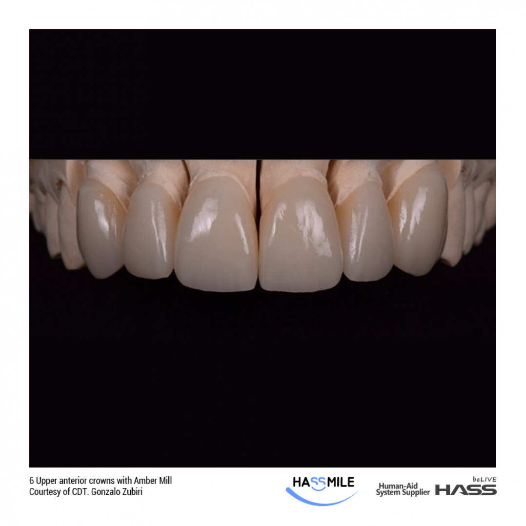 Upper anterior crowns with Amber Mill