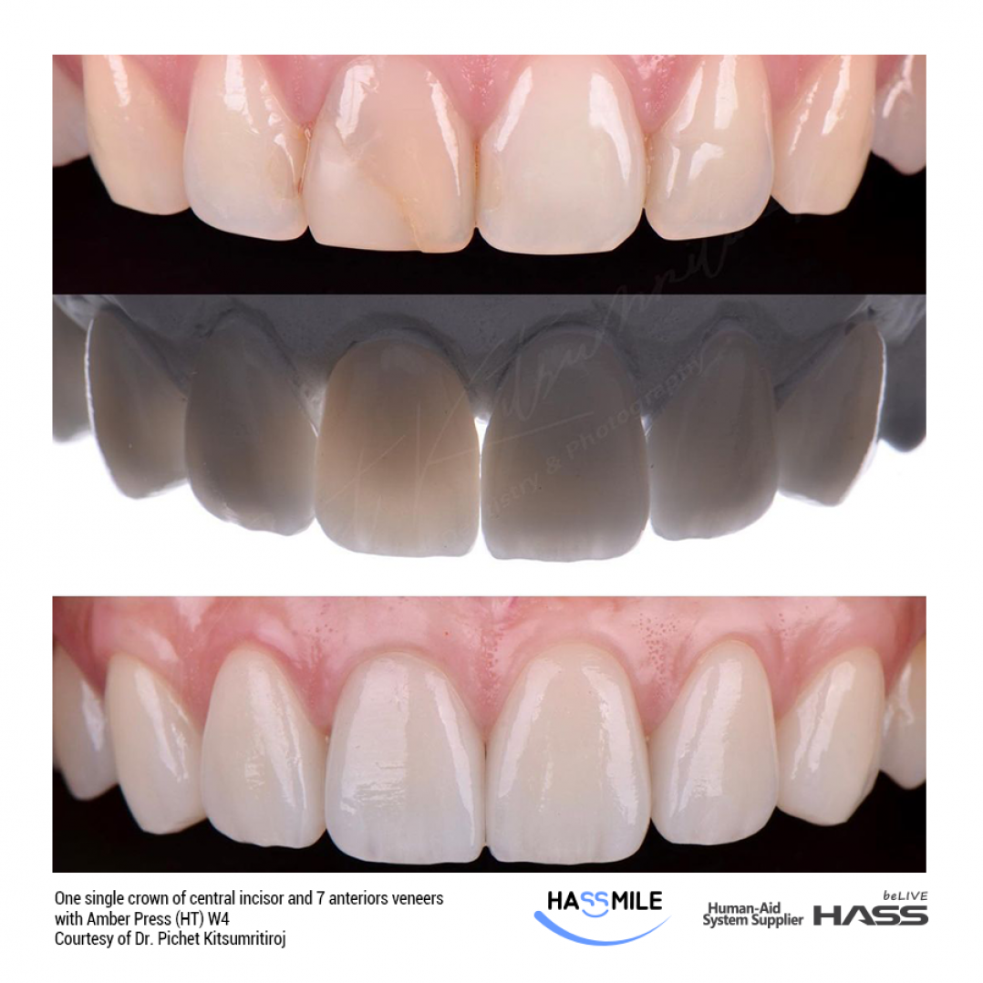 하스바이오 HASSBIO AmberPress dental-press Lithium-disilicate veneers