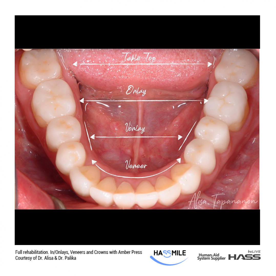 HASSBIO AmberPress Lithium-disilicate dental-press