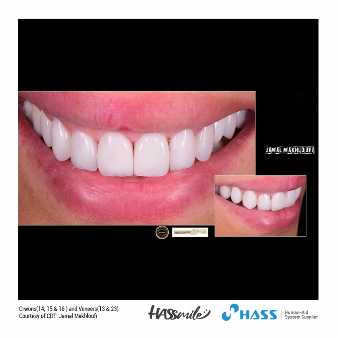 HASSBIO AmberPress Lithium-disilicate dental-press